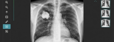 Can an X-Ray Show Cancer in the Bones?