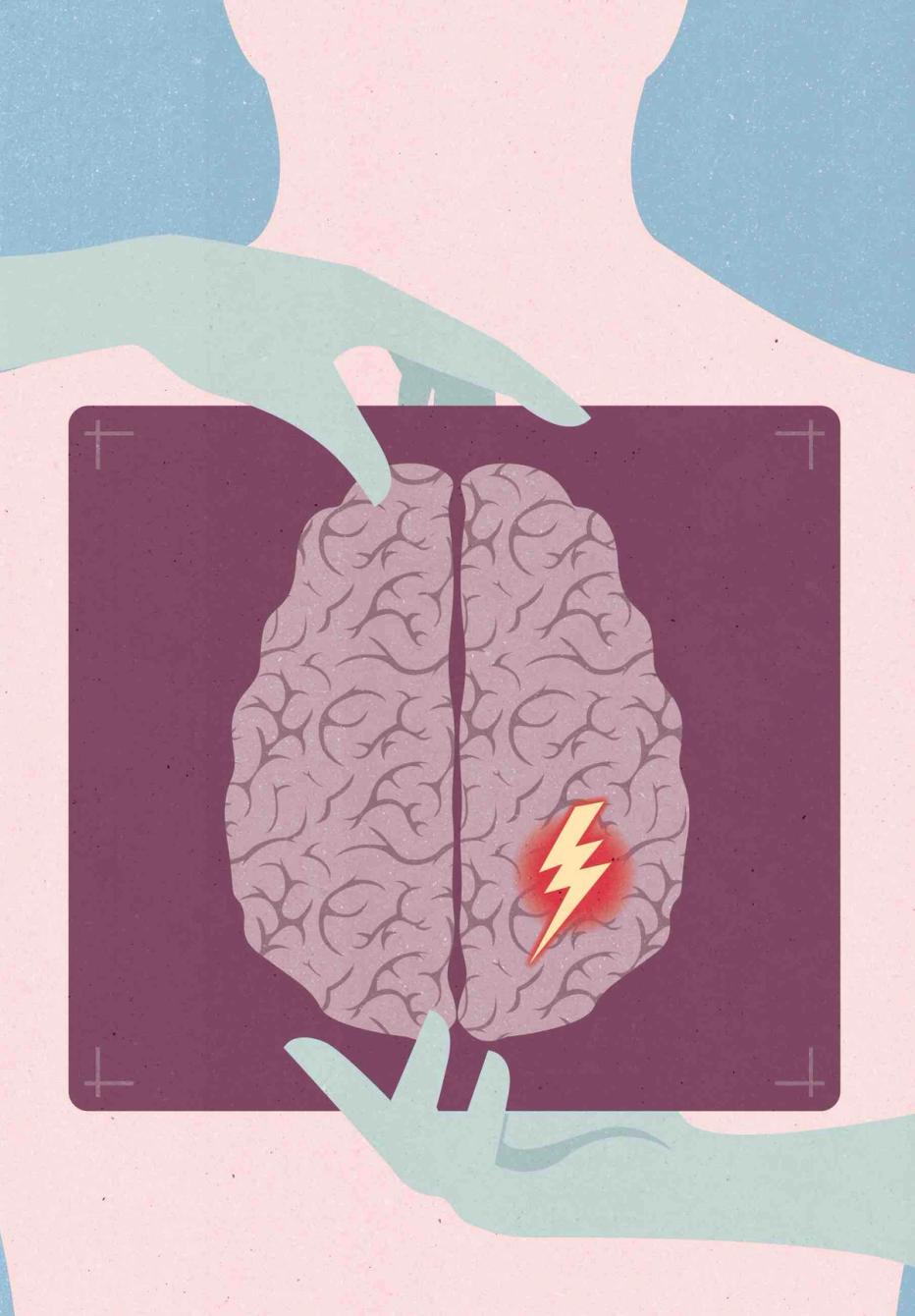 Illustration som visar stroke.