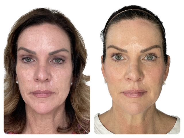 Original paired front view photographs of the same patient, Before on the left and After on the right.