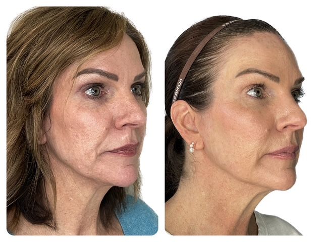 Original paired three-quarter view photographs of the same patient, Before on the left and After on the right.
