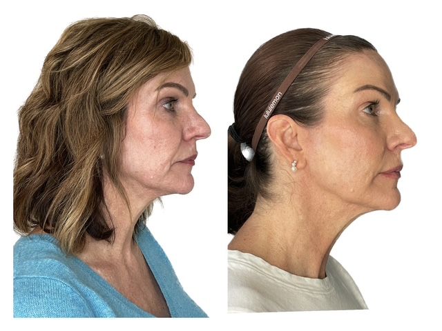 Original paired profile view photographs of the same patient, Before on the left and After on the right.