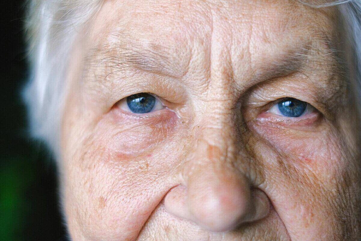 Age-Related Macular Degeneration