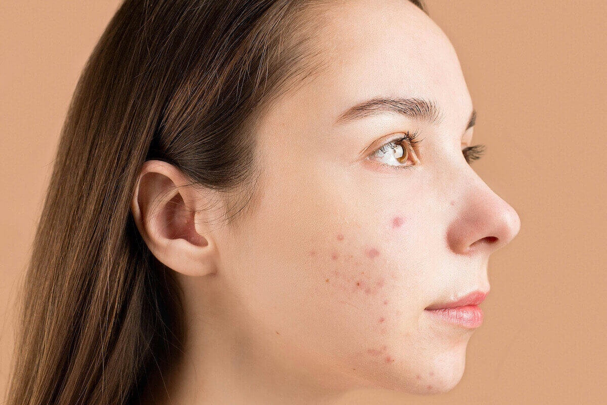 When Does Acne End?