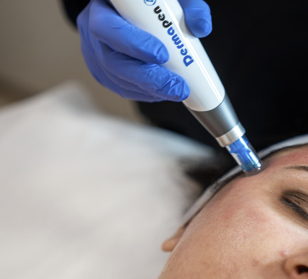 Microneedling (Dermapen) aftercare