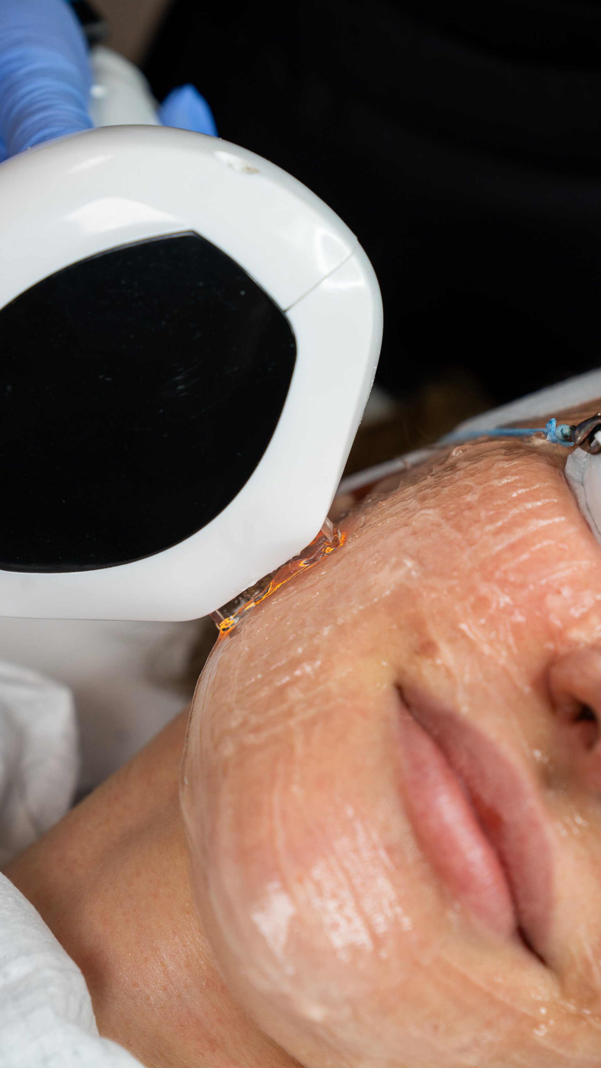 Preparing for Rosacea Treatment Lumecca