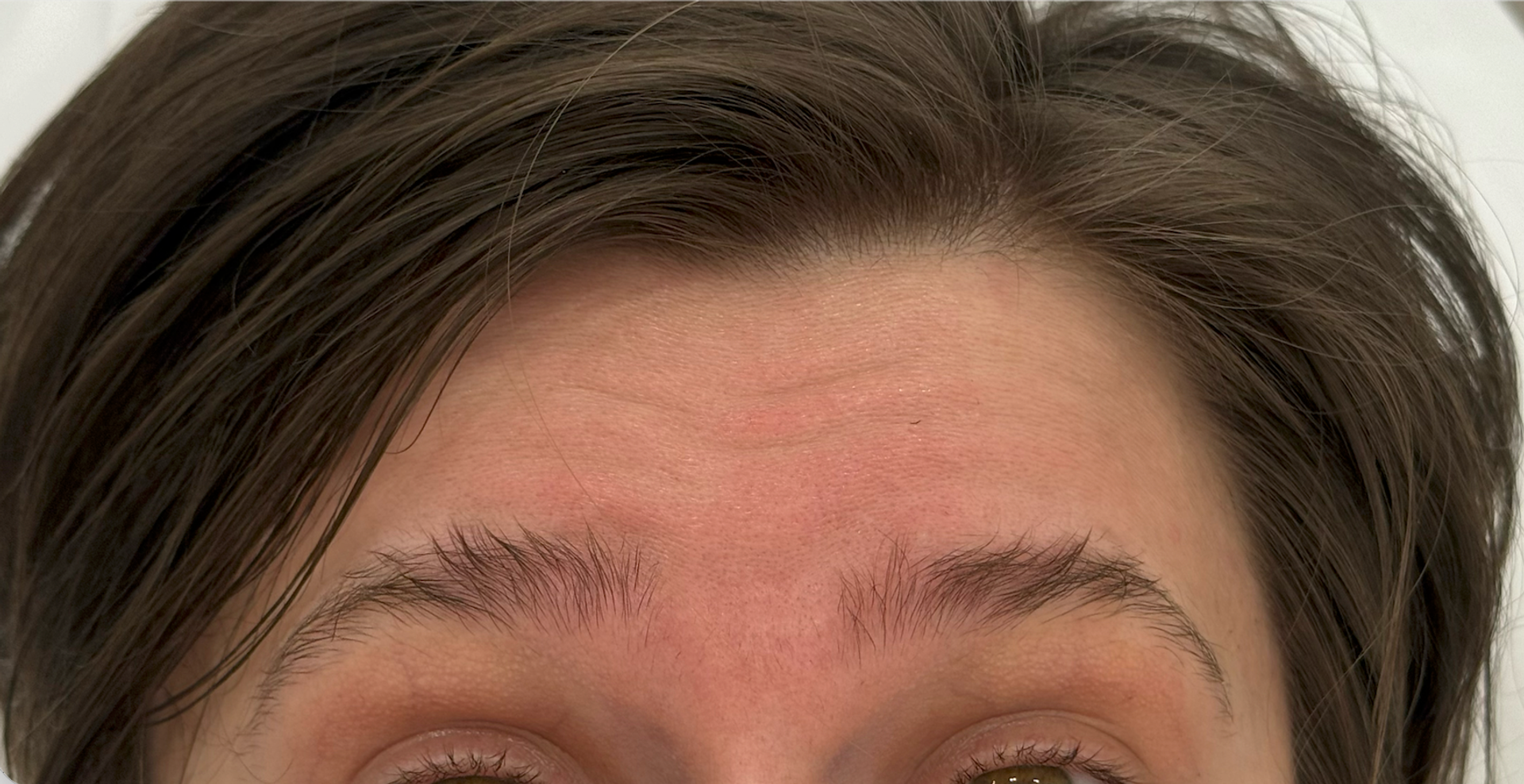 Anti-Wrinkle Injections before treatment