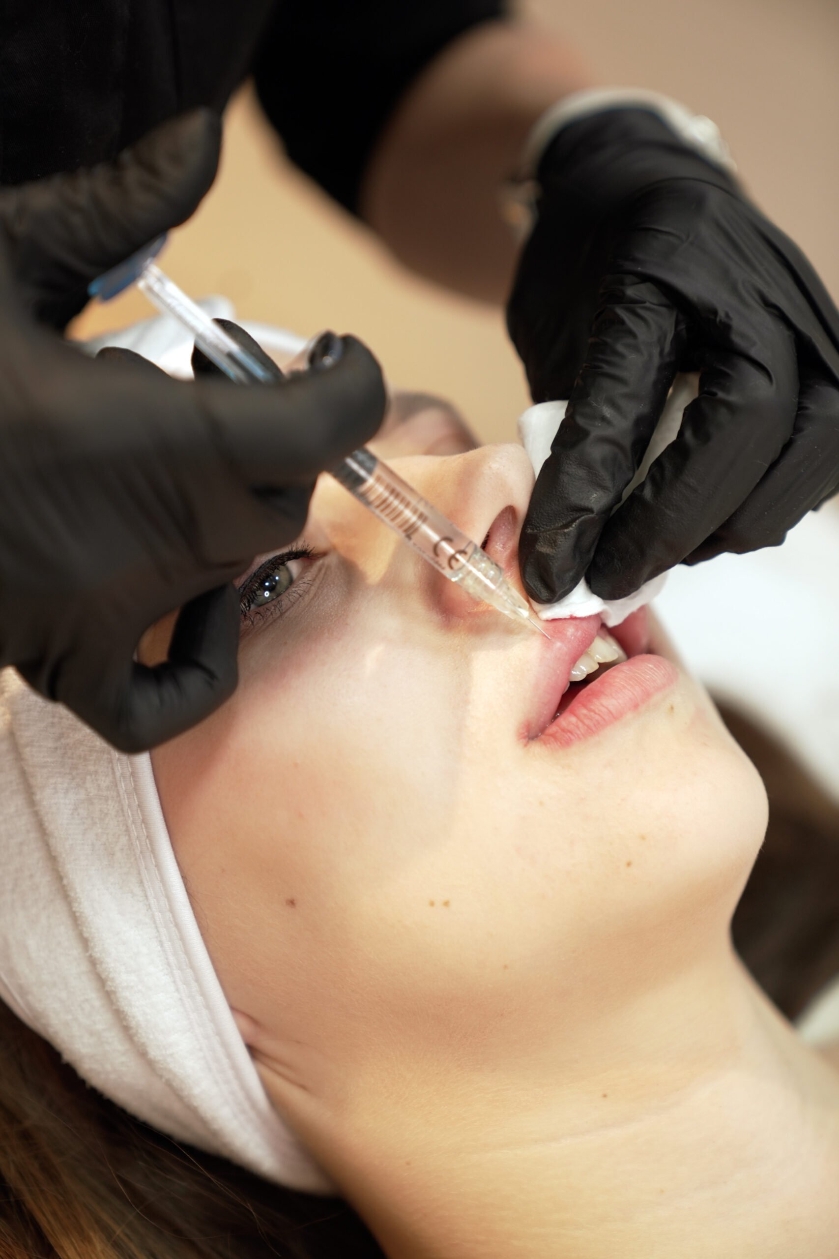 Filler Removal (Hyaluronidase)