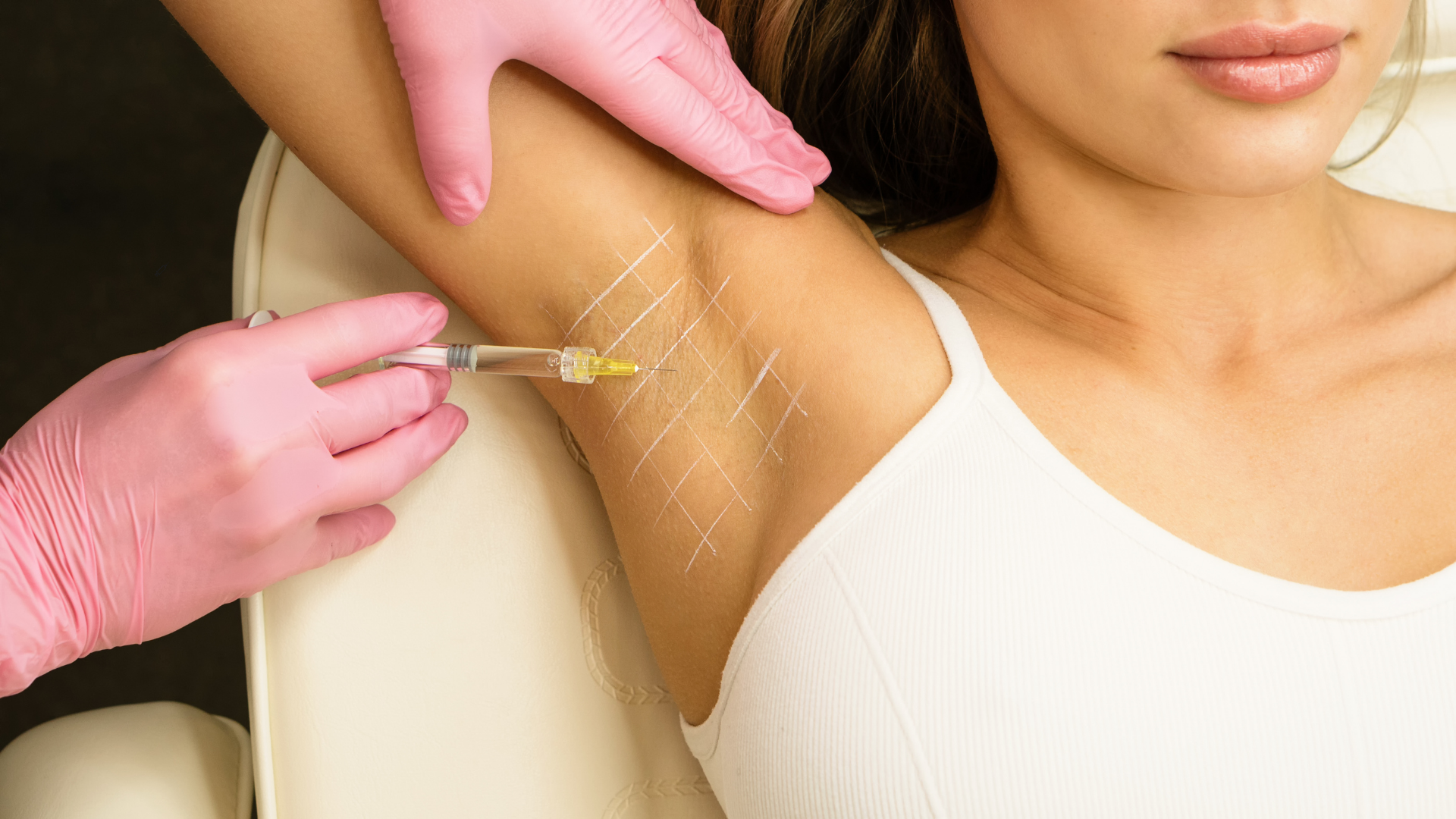 Excessive Sweating (Hyperhidrosis): Causes, Treatment & How Botox Can Help This Summer