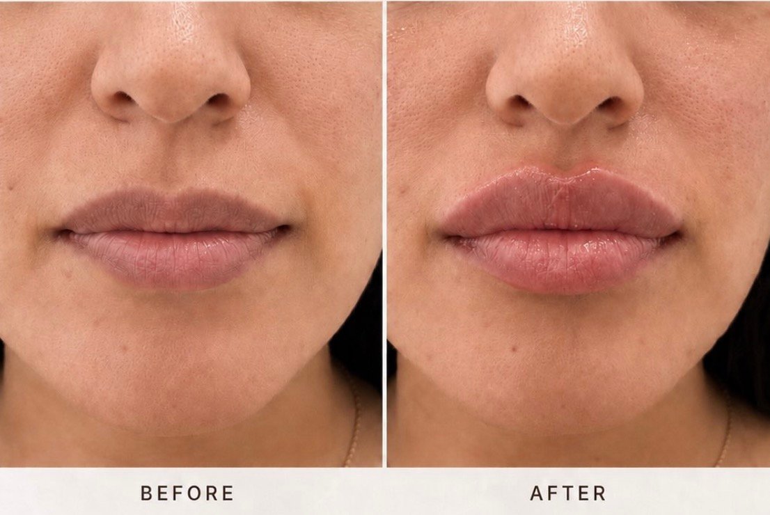 Lip filler before&after