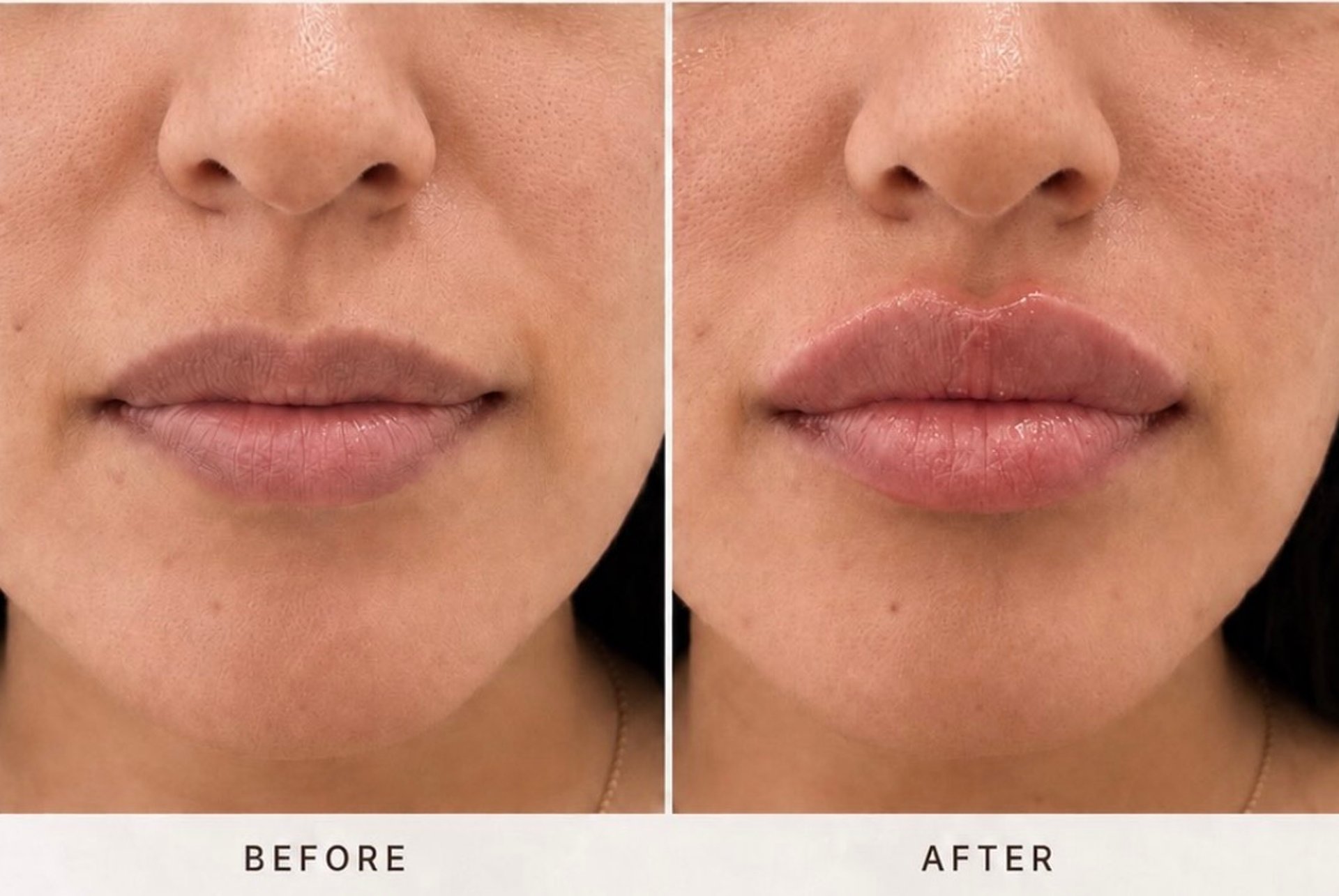 Lip filler before&after