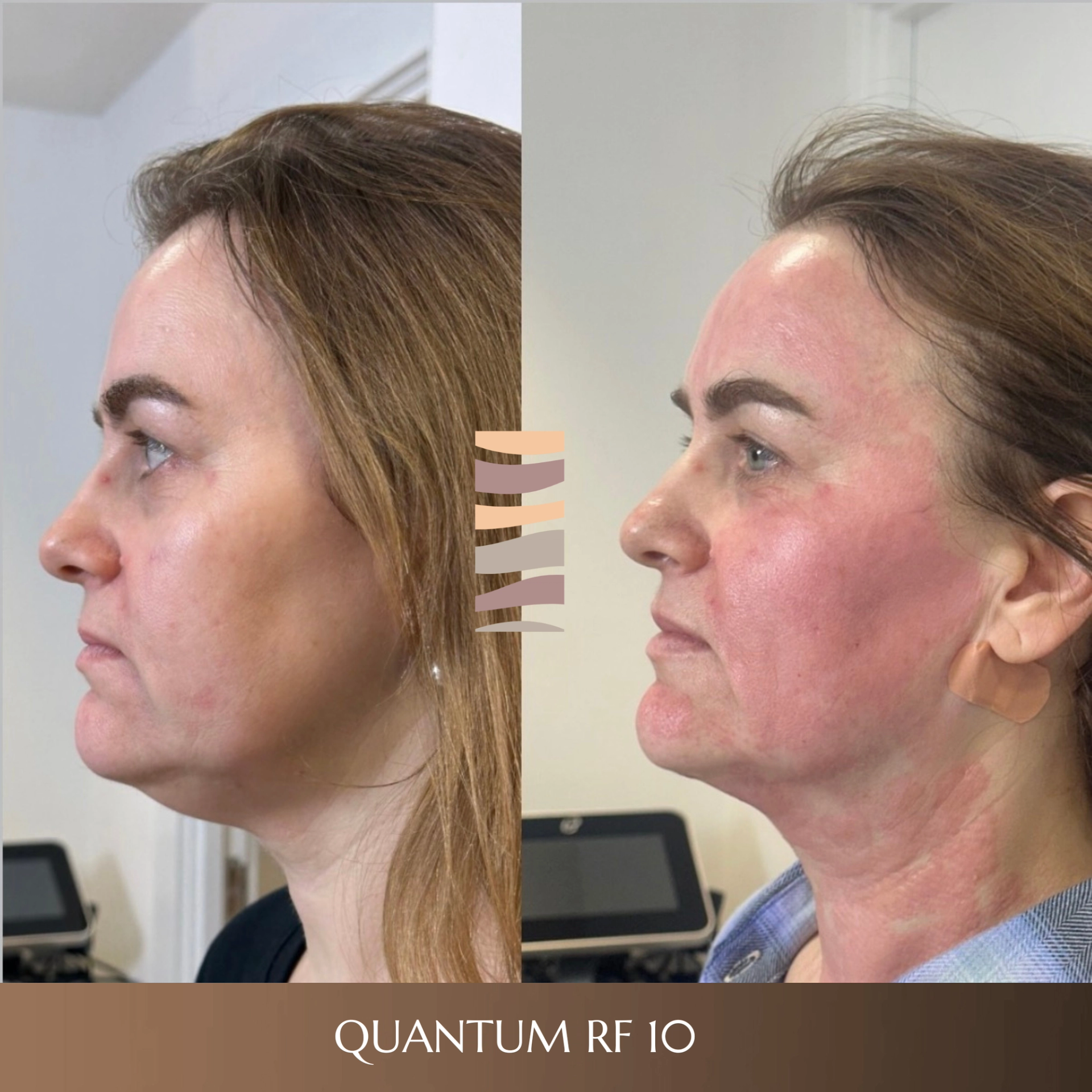 QuantumRF 10 and Morpheus8 Burst before and after results at Innoderm Aesthetic Clinic