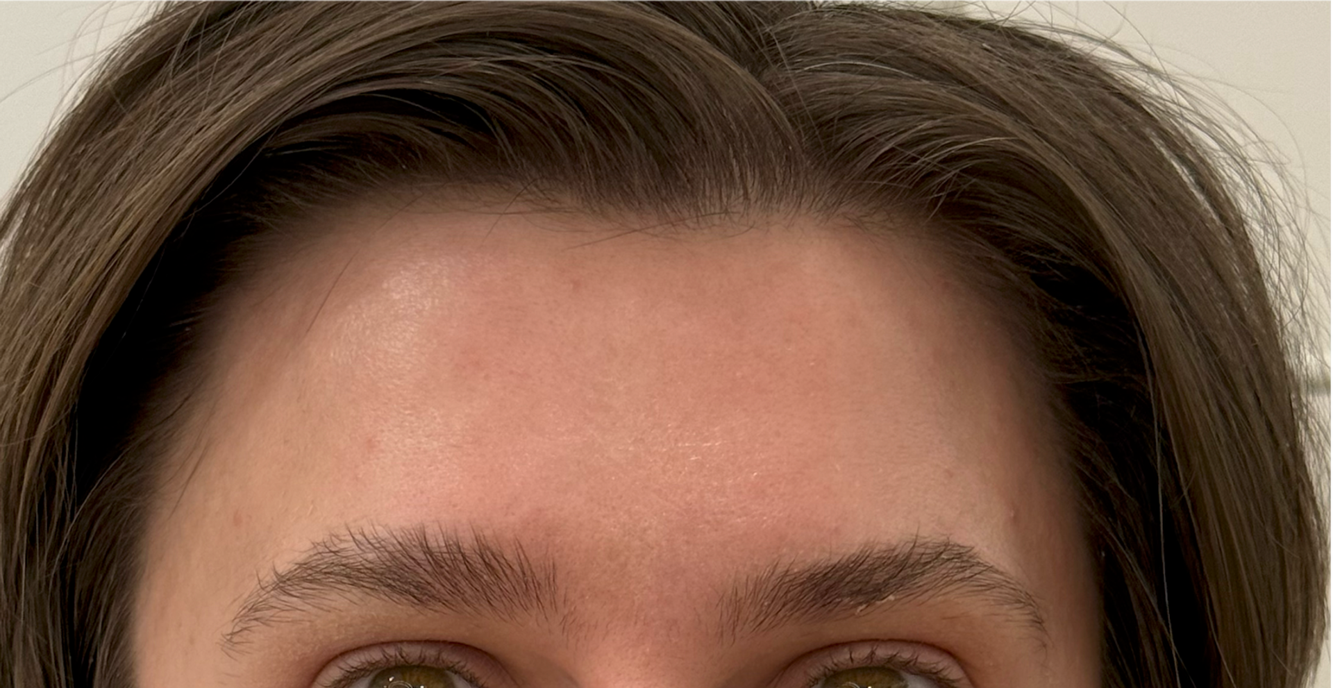 Anti-Wrinkle Injections after treatment