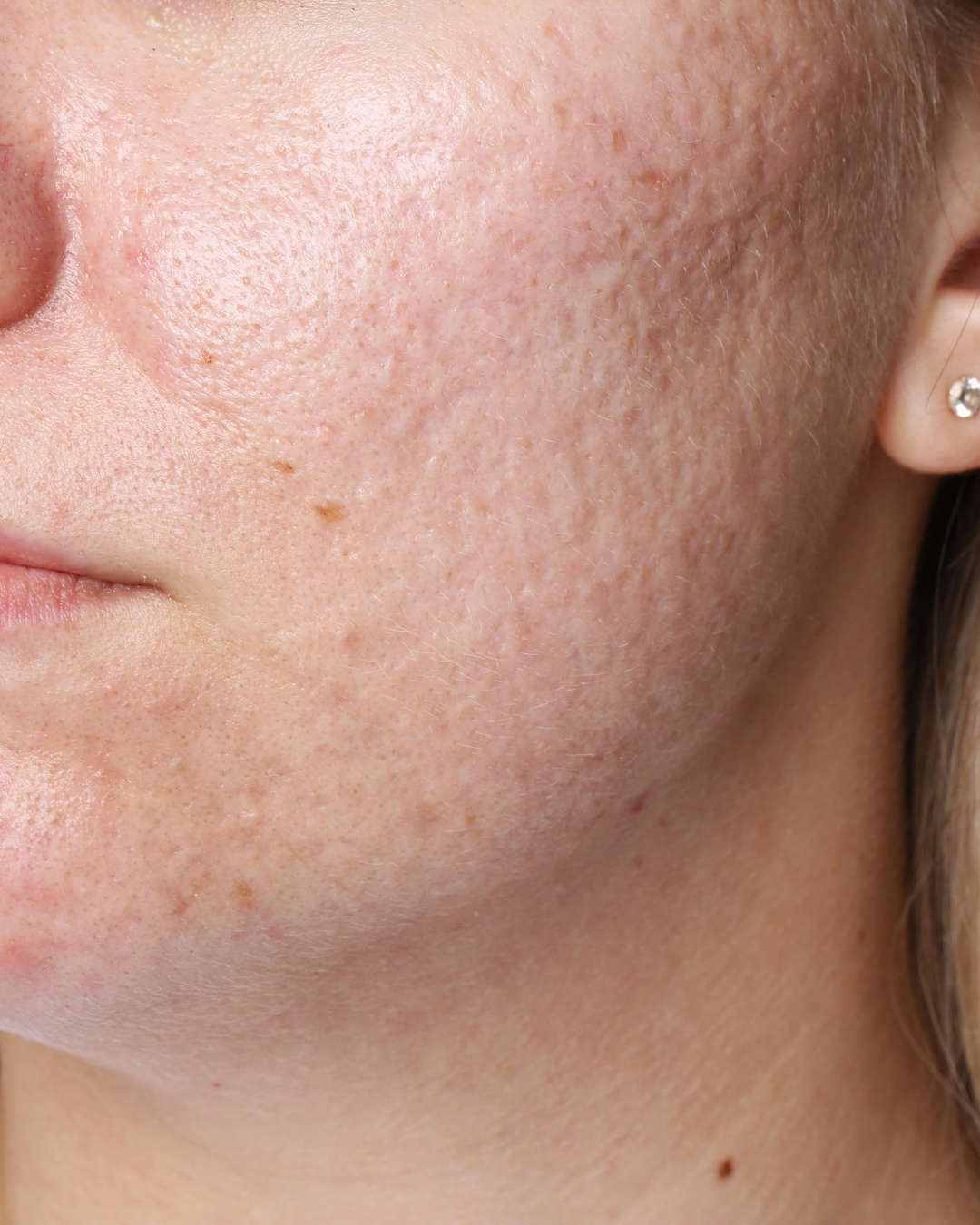 Skin Texture & Pores