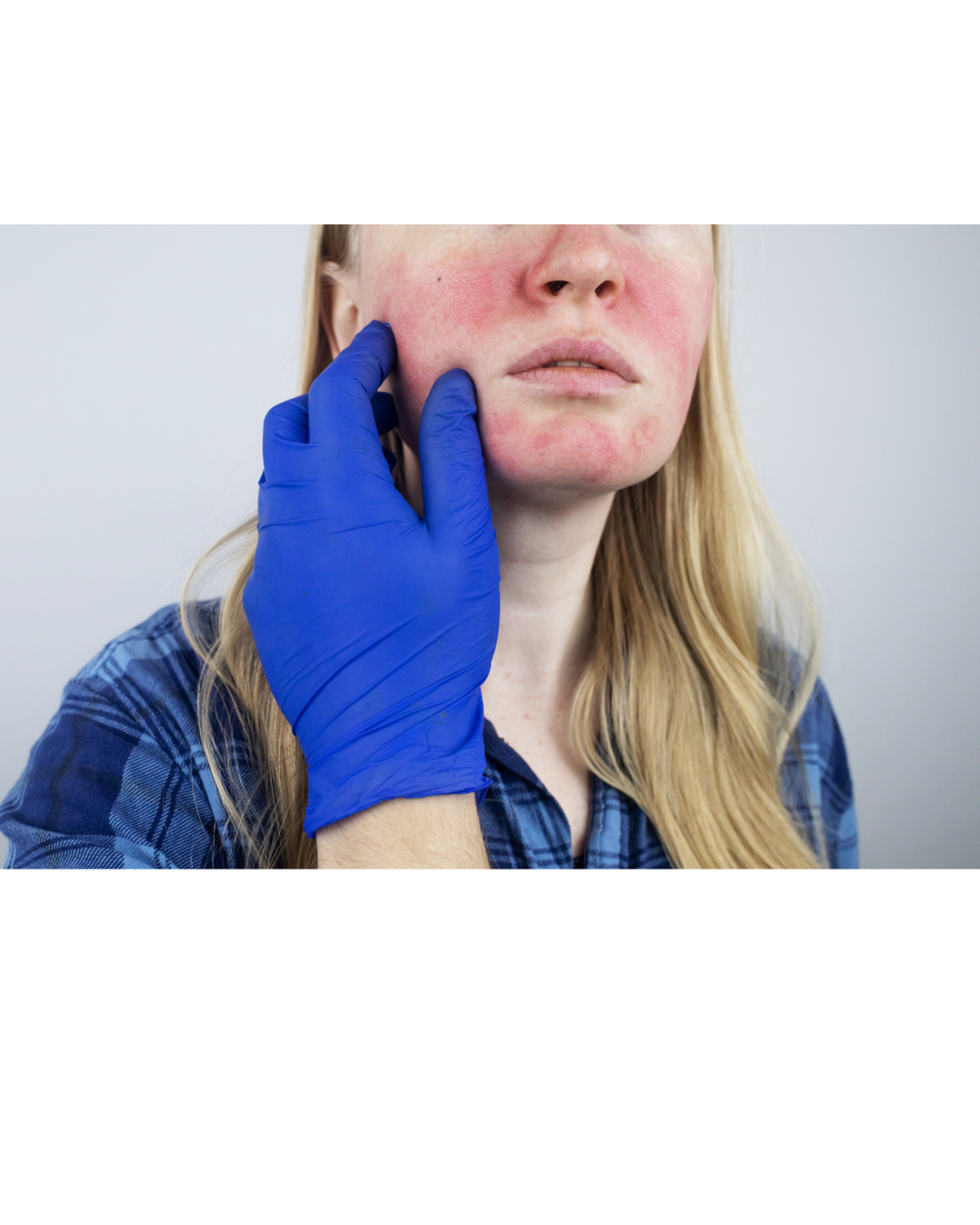 Rosacea Explained: Can You Get Rid of Redness Forever?