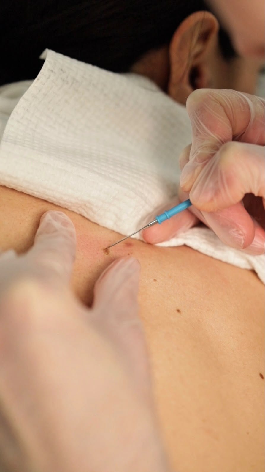 Electrocoagulation – Skin Tag Removal aftercare