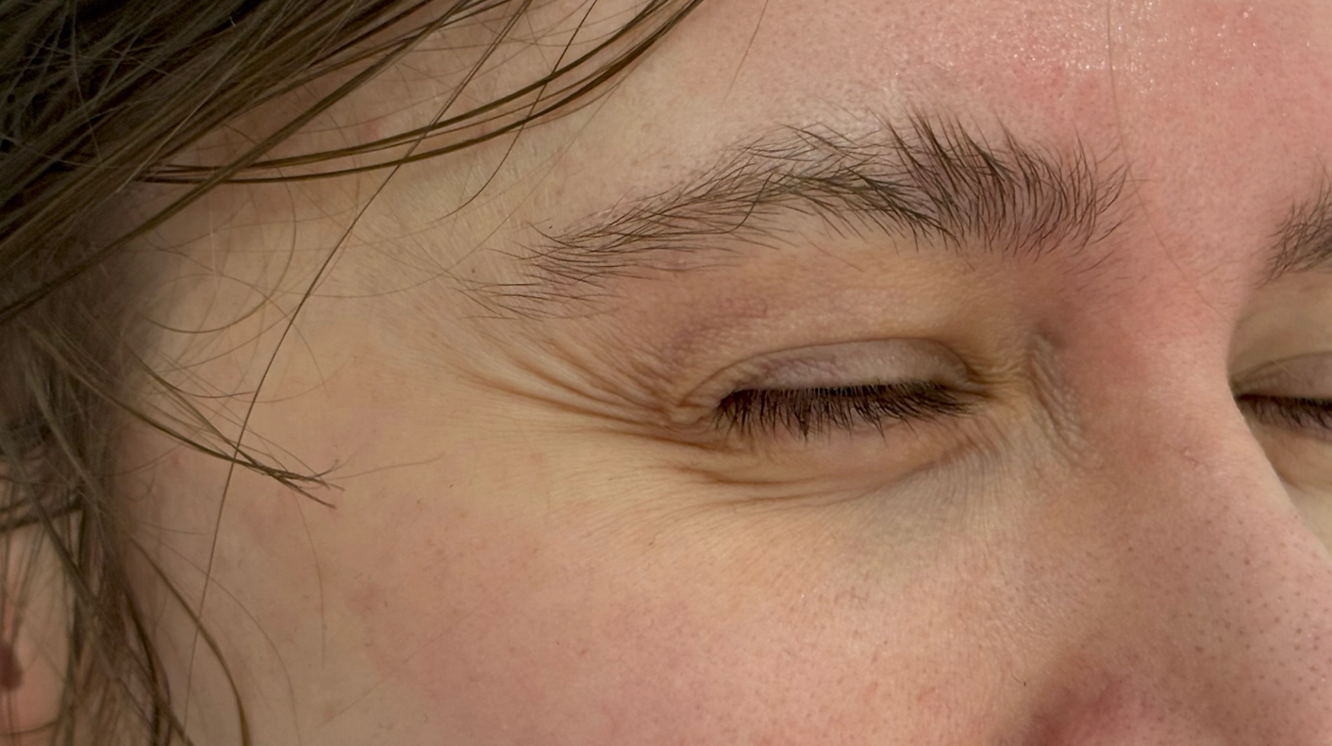 Anti-Wrinkle Injections before treatment