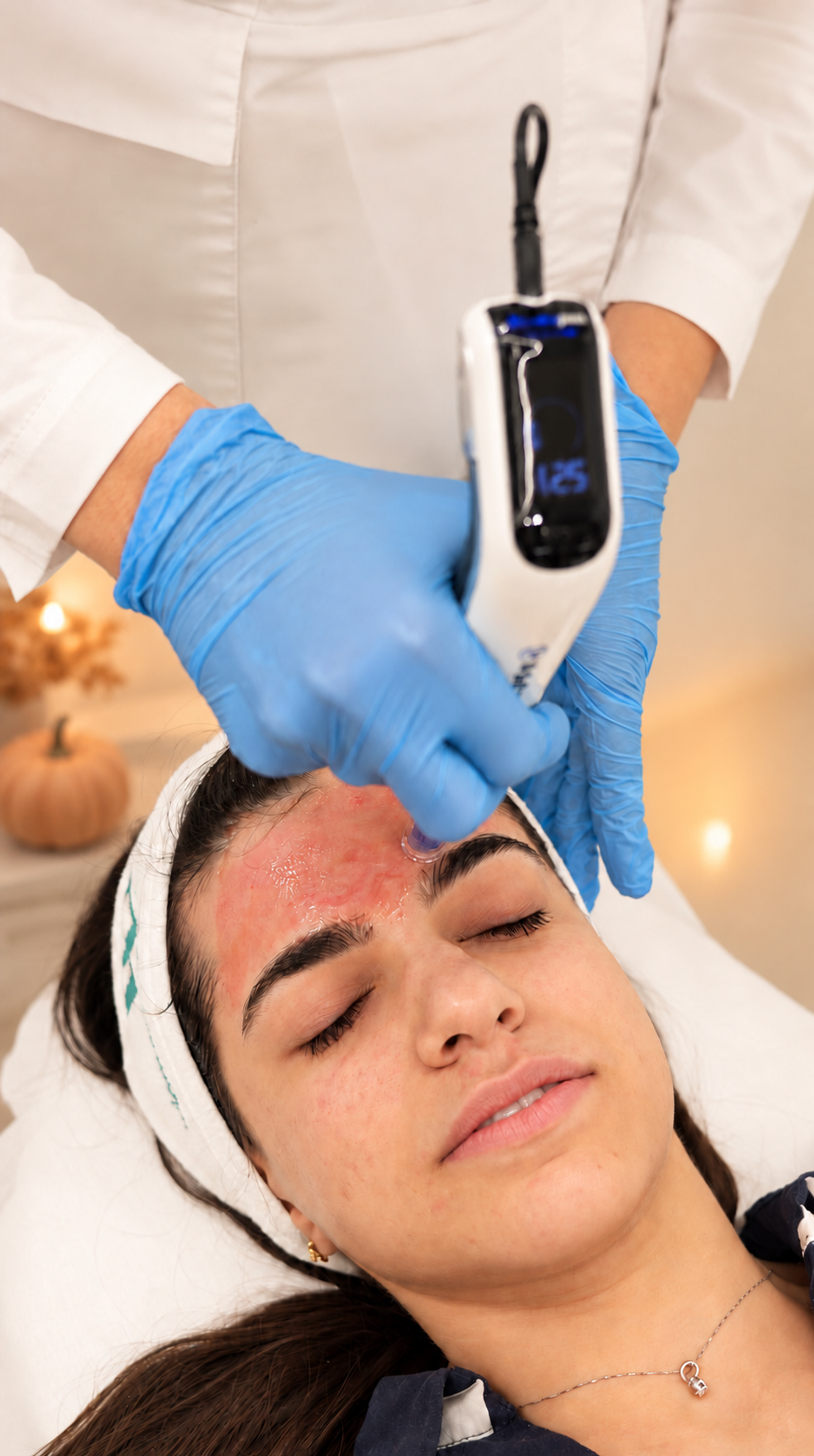 Vampire Facial Alternative: Dermapen + RE:Q | Innoderm