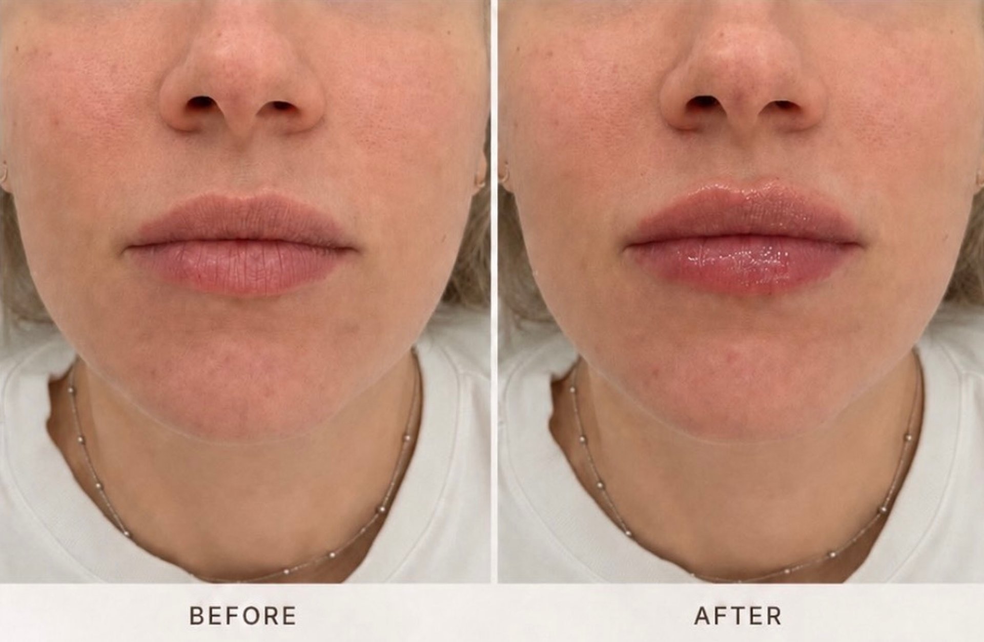 Lip filler before&after