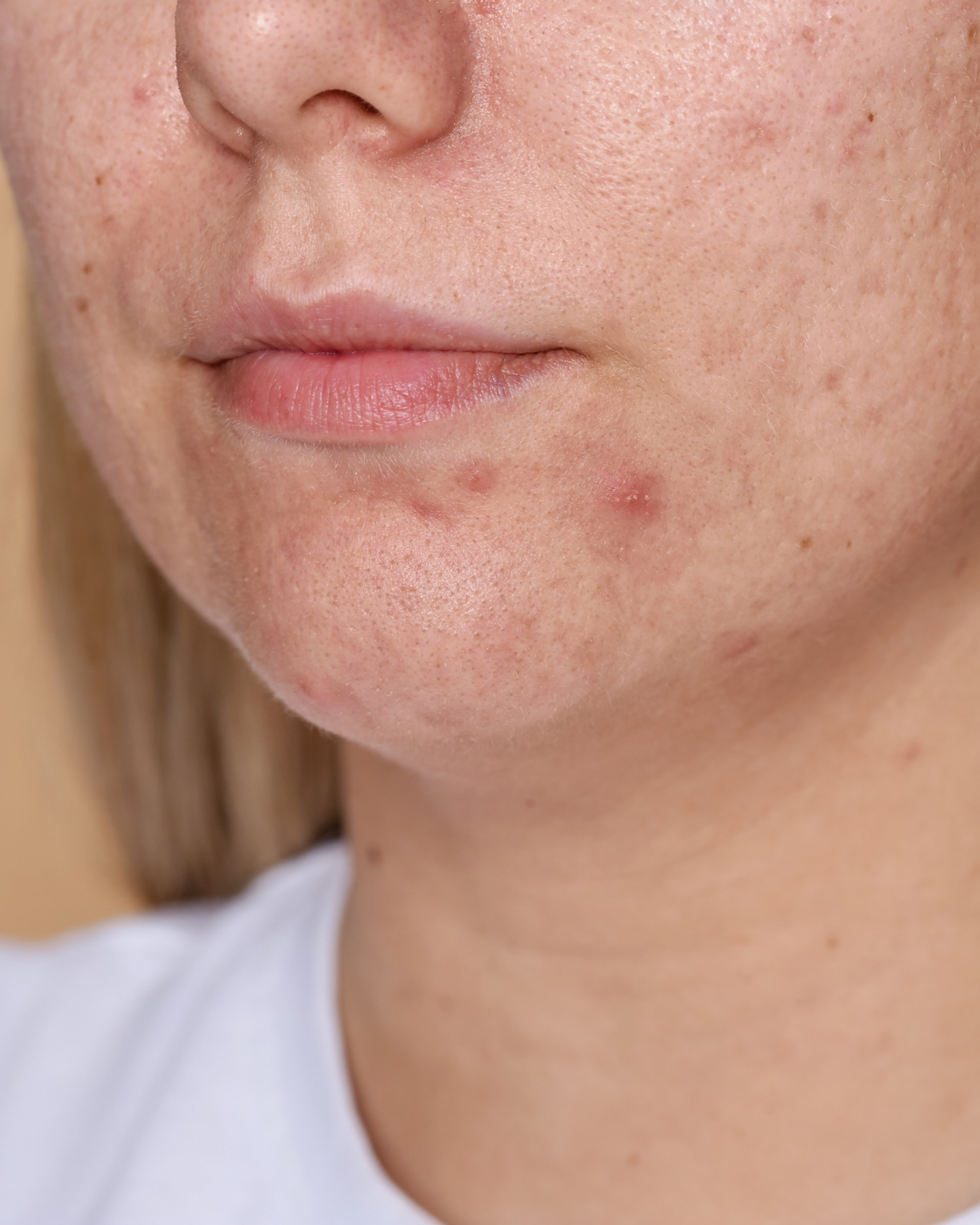 Acne & Acne Scars