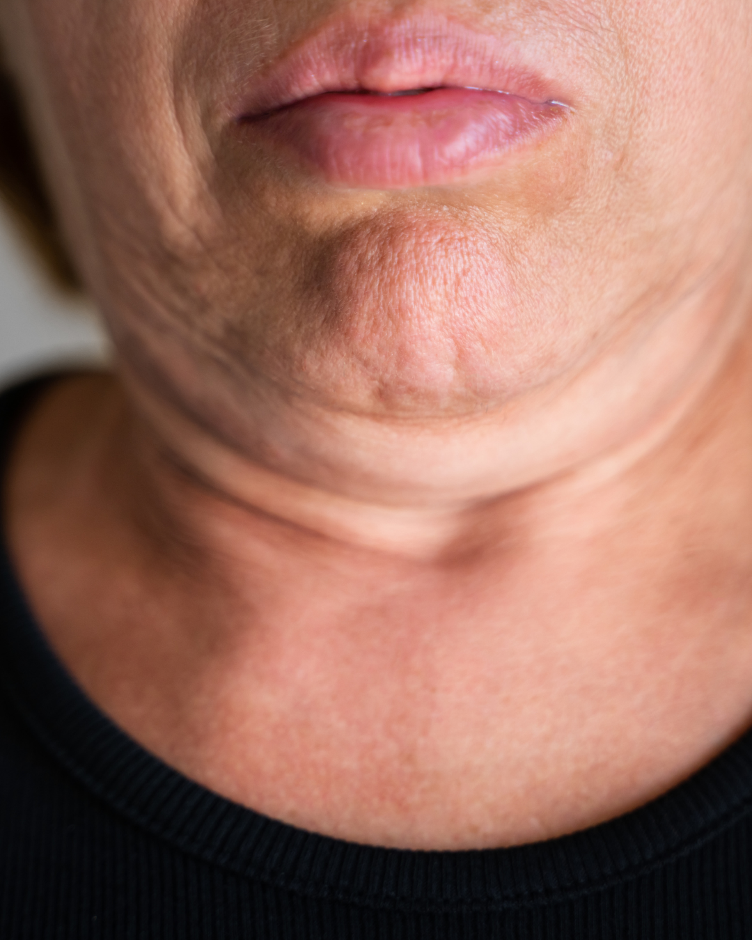 Skin Tightening & Sagging