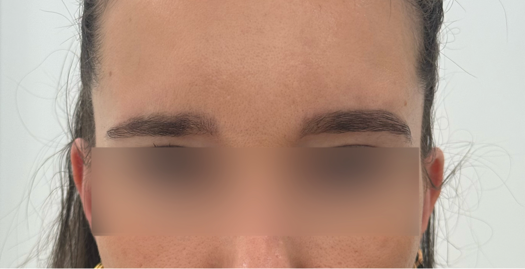 Anti-Wrinkle Injections after treatment