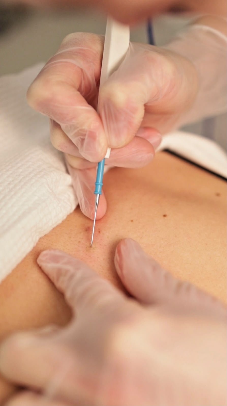 Electrocoagulation – Skin Tag Removal