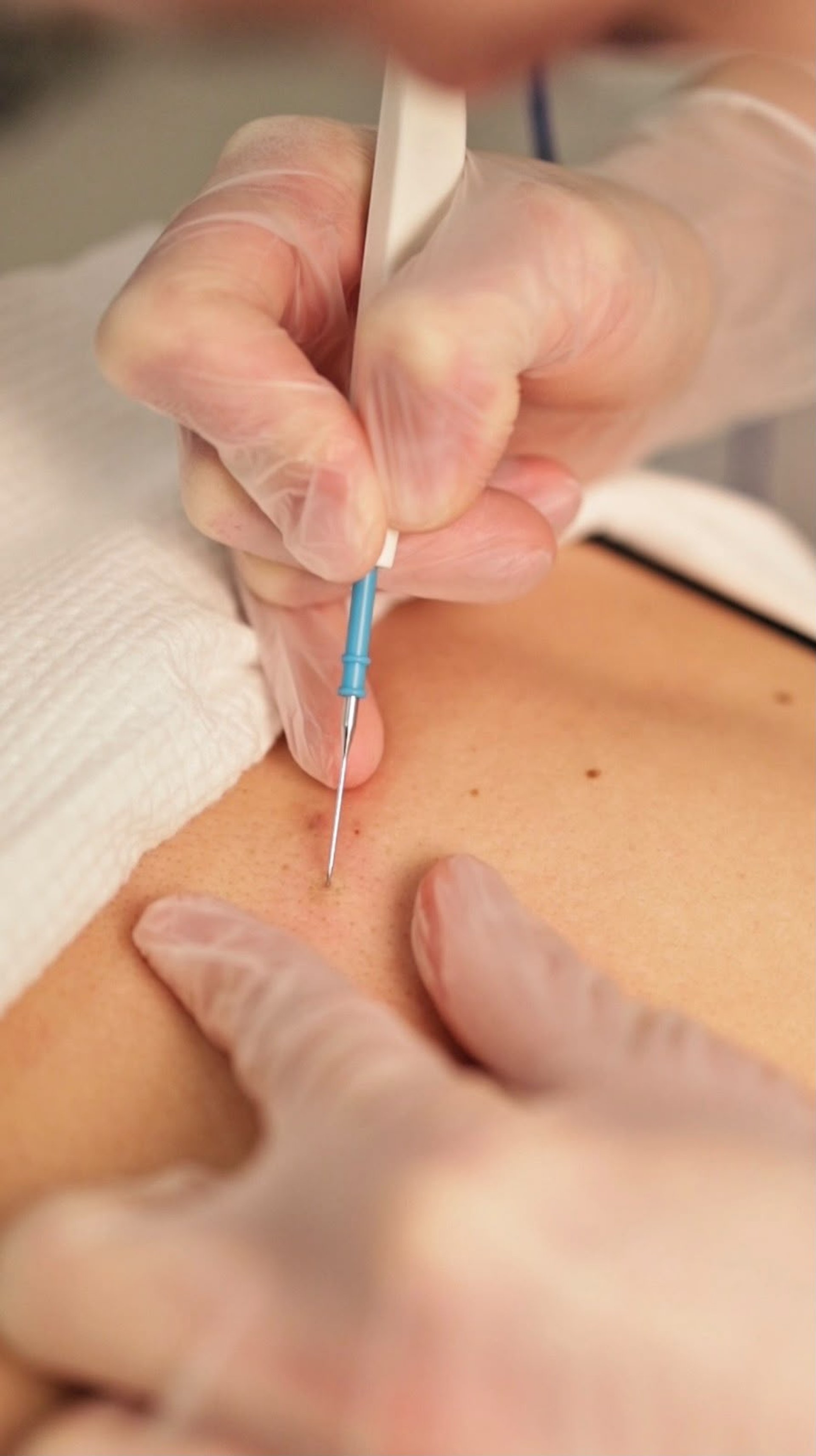 Electrocoagulation – Skin Tag Removal
