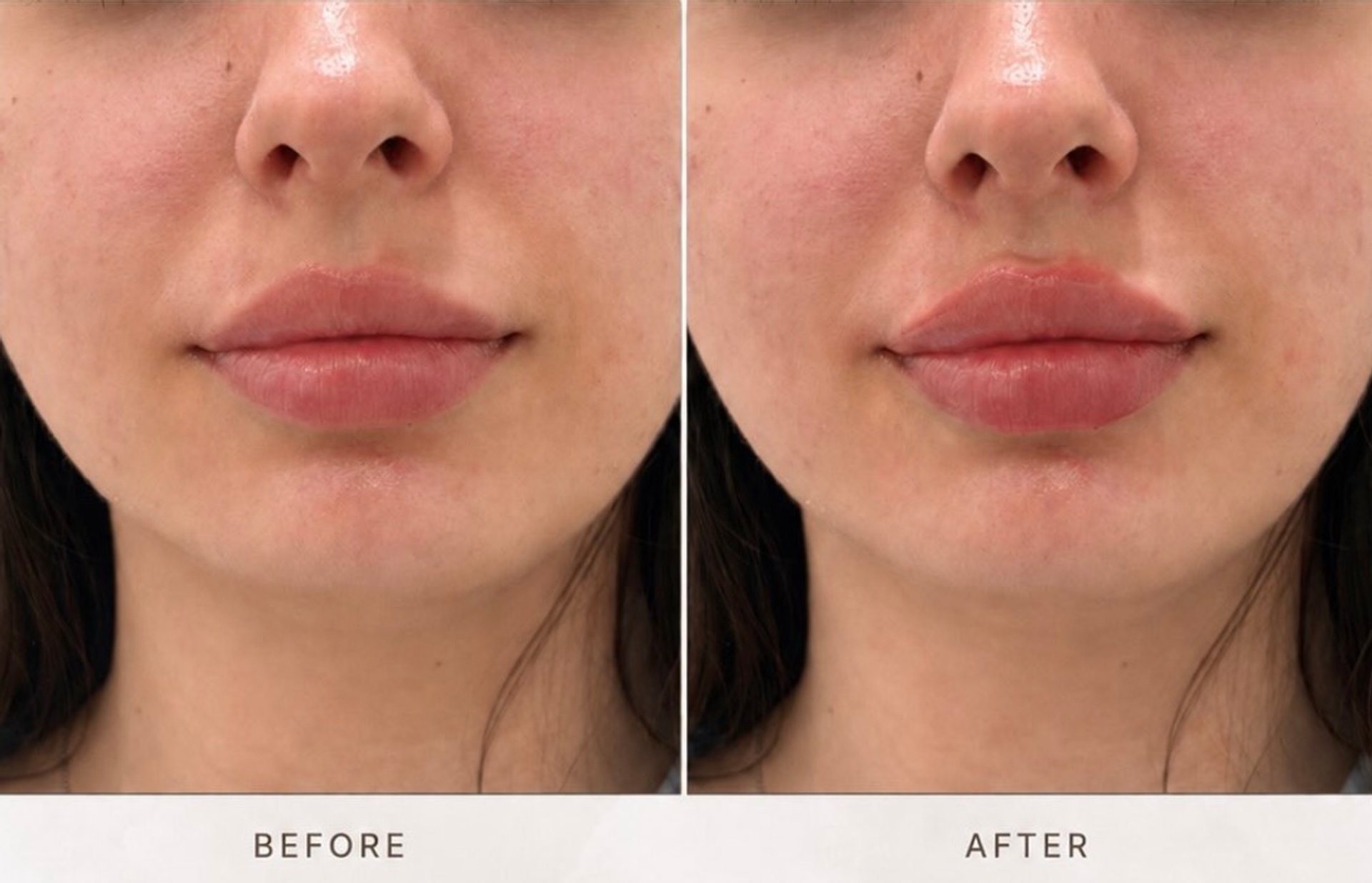 Lip filler before&after