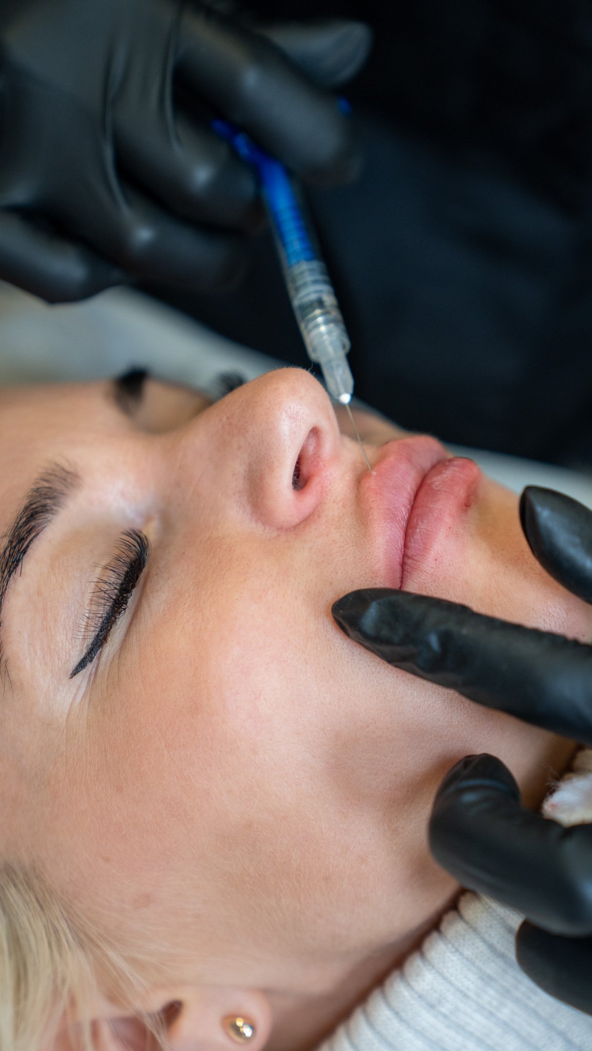 Preparing for Lip Fillers