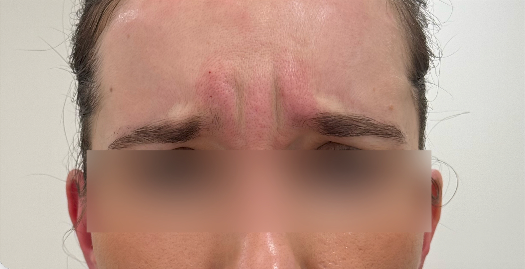 Anti-Wrinkle Injections before treatment
