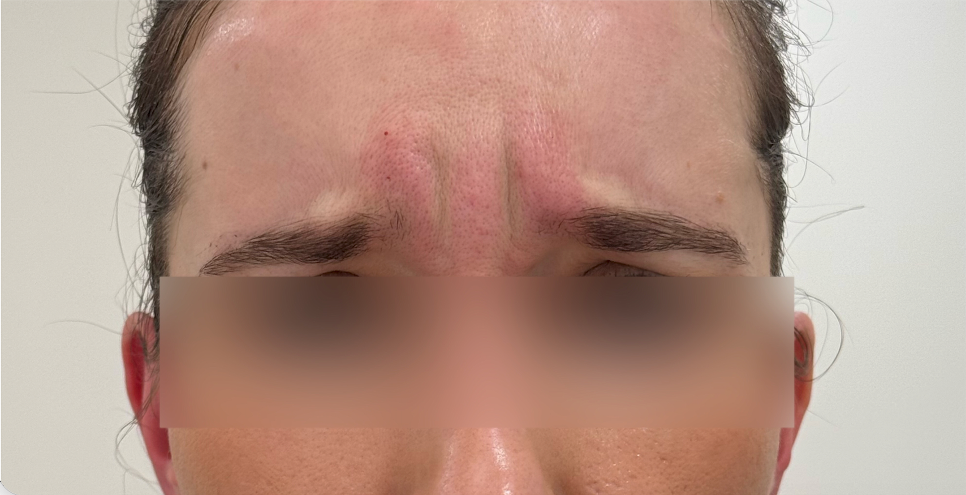 Anti-Wrinkle Injections before treatment