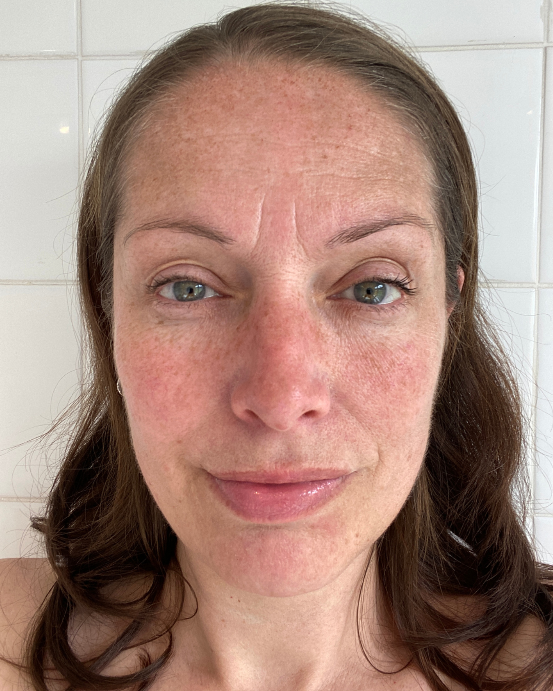 Post-summer pigmentation