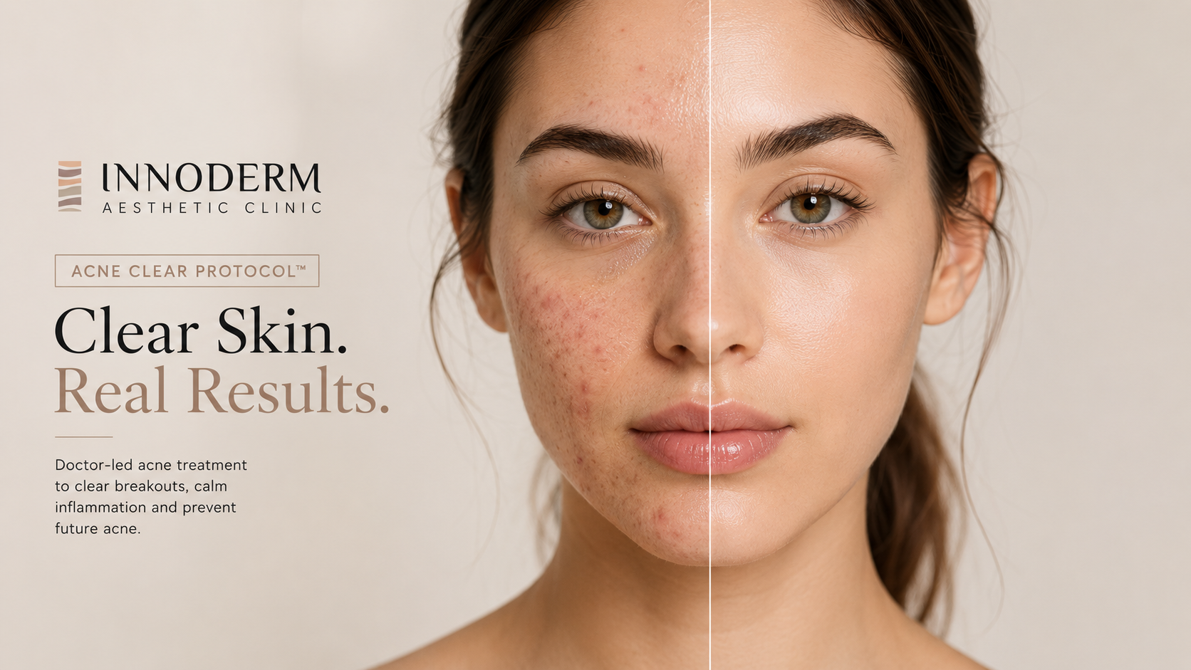 How to Get Rid of Acne: Why a Personalised Approach Makes All the Difference