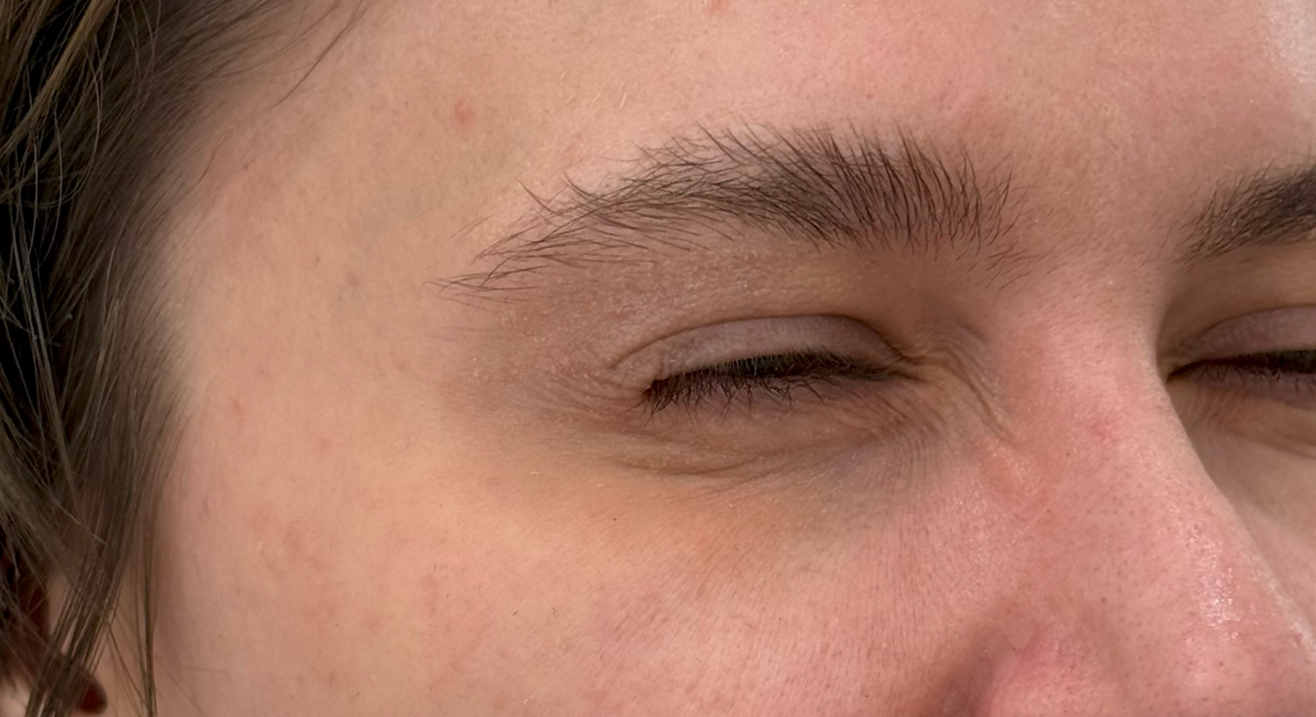 Anti-Wrinkle Injections after treatment