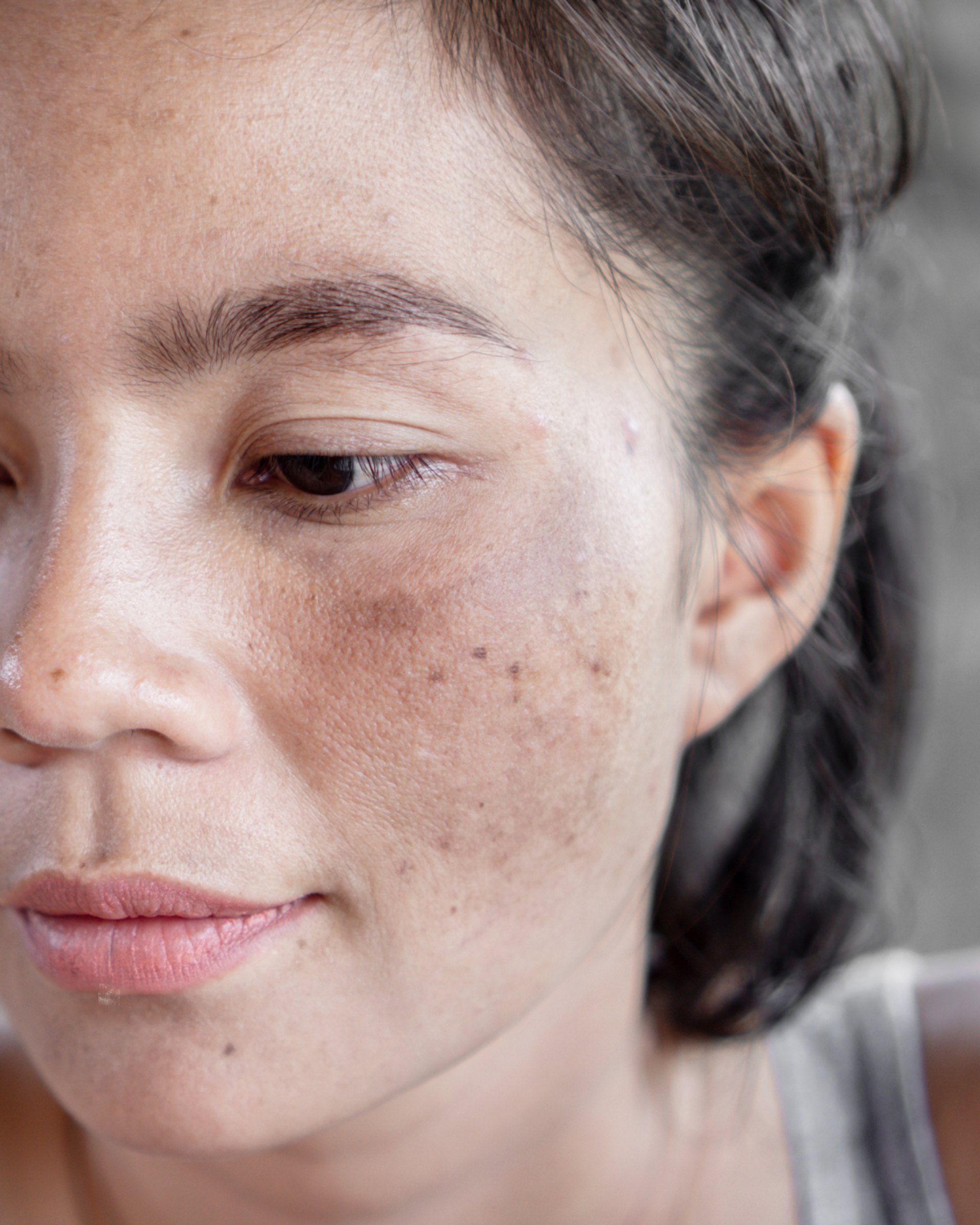 Post-Summer Pigmentation: Why It Happens and How to Treat It