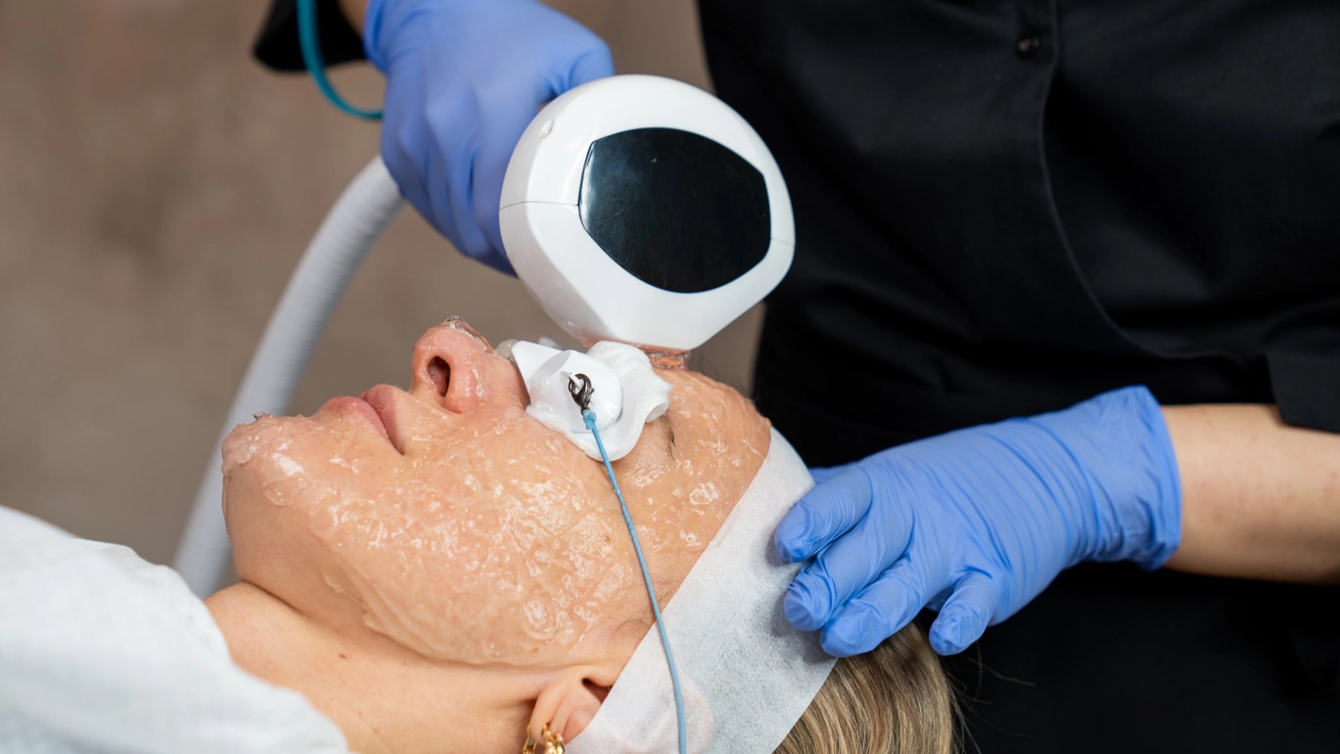 Rosacea Treatment Lumecca