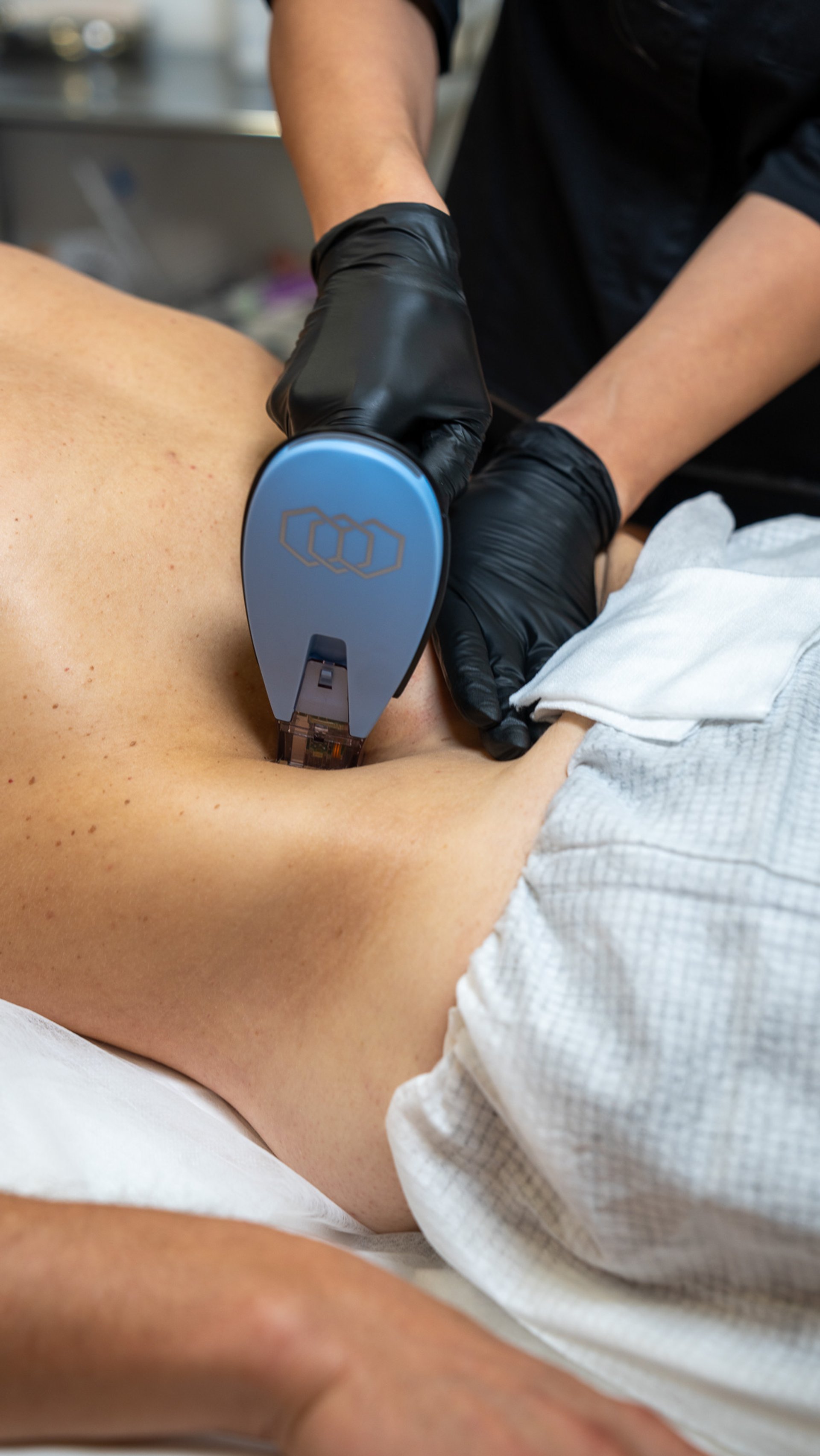Special offer: Morpheus8 body - any 3 areas ONLY £950