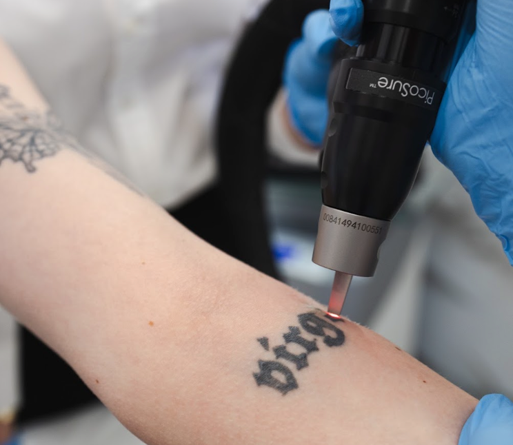 Tattoo removal