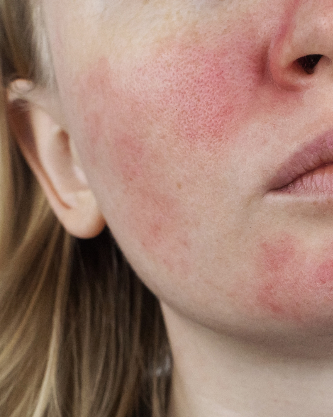 Rosacea & Redness