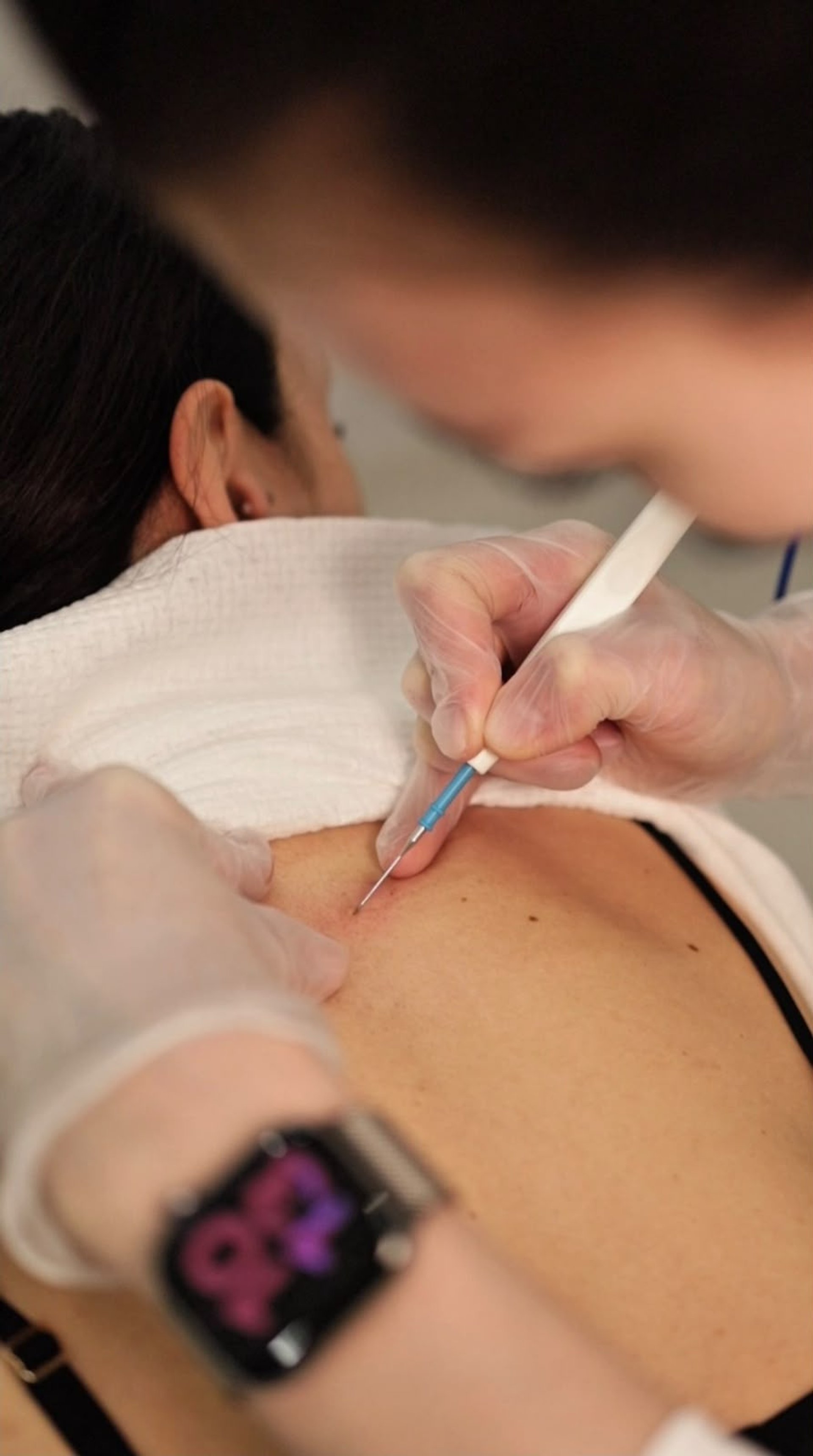 Preparing for Electrocoagulation – Skin Tag Removal