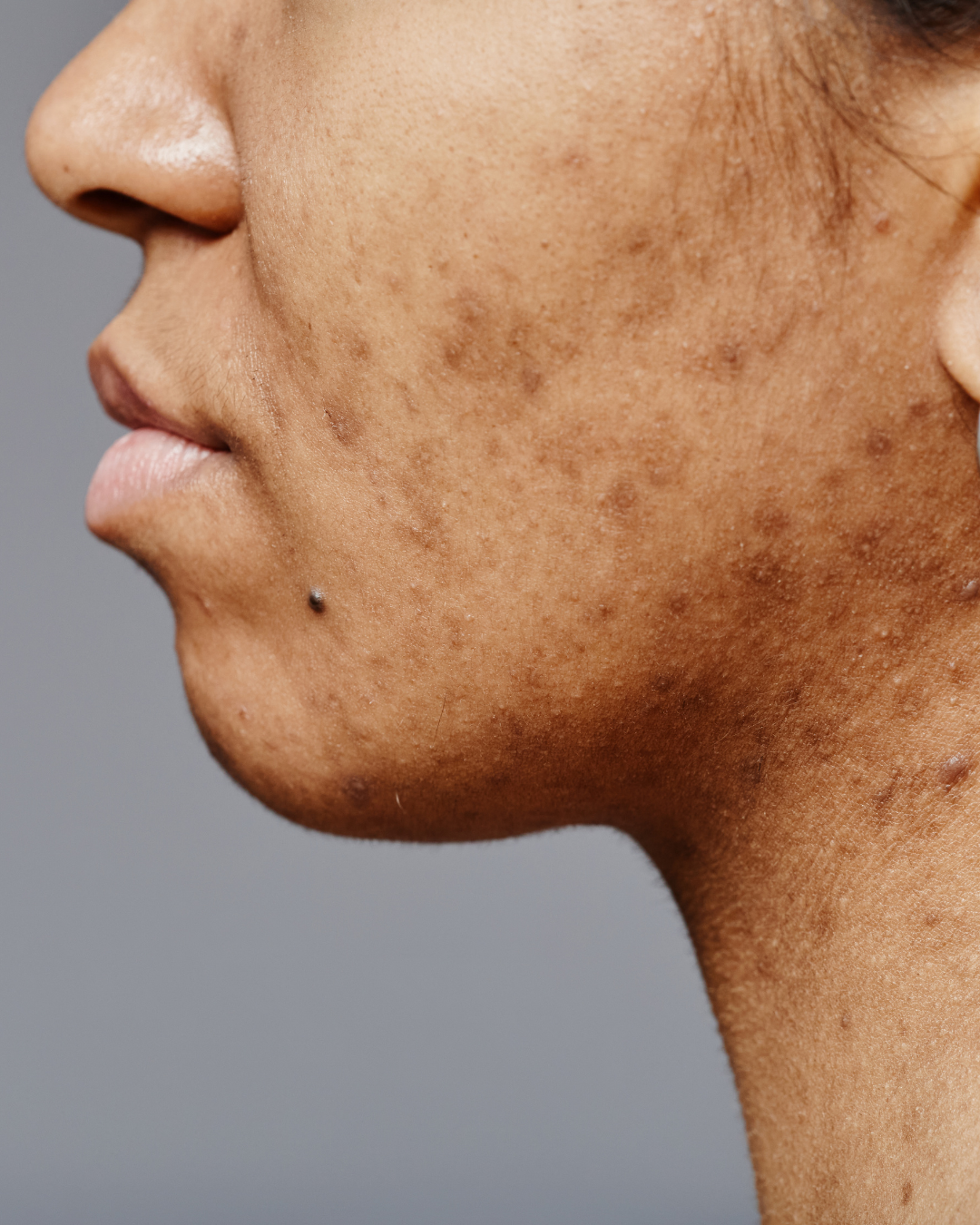 Pigmentation & Dark Spots