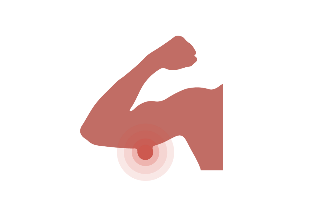 Bumps on Upper Arms Causes Bicep and Tricep Lumps Buoy