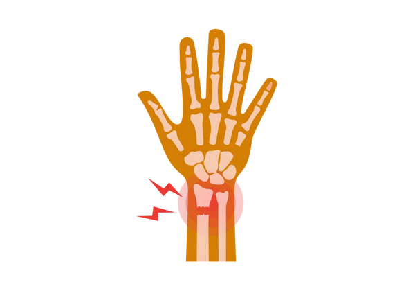 An illustration of a hand and wrist. The bones of the hand, wrist, and forearm are visible, and the bone on the left of the forearm is broken at the wrist. A semi-transparent red circle and two red lightning bolts emanate from the break.