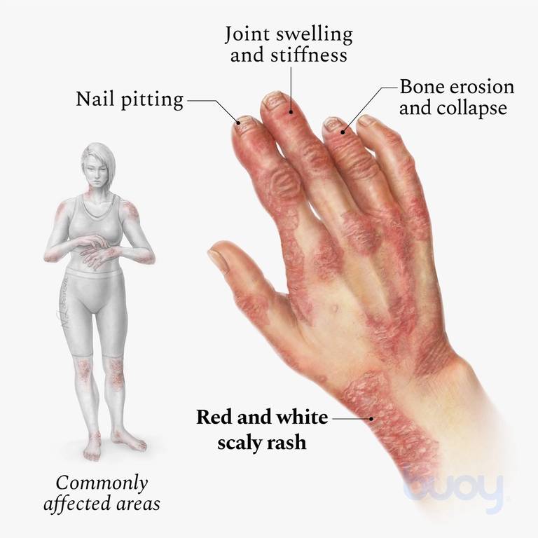 Artritis psoriásica que afecta a las manos.