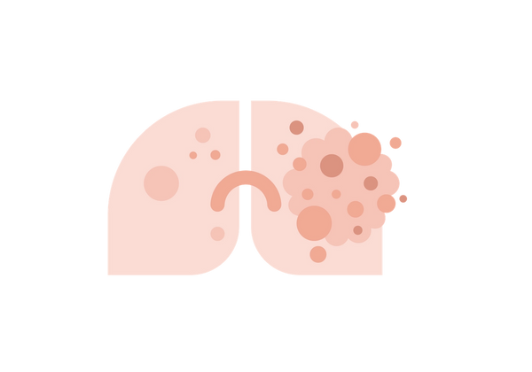 Lung with cancer growth
