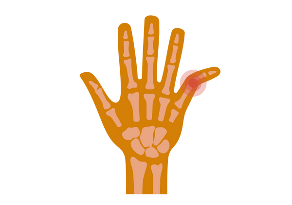 Eine Illustration einer Hand mit ausgestreckten Fingern. Die Hand hat einen mittleren Karamellton und die Knochen sind in einem helleren Farbton durch die Haut sichtbar. Der kleine Finger rechts ist am zweiten Knöchel schräg nach außen gebogen. Rote Kreise gehen vom Gelenk aus und betonen den Bereich.