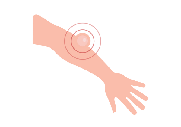 Uma diagonal do antebraço do canto superior esquerdo ao canto inferior direito. Um caroço está próximo ao cotovelo com círculos concêntricos vermelhos emanando dele.
