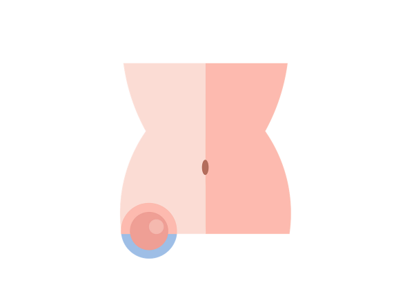 Um caroço no abdômen inferior direito