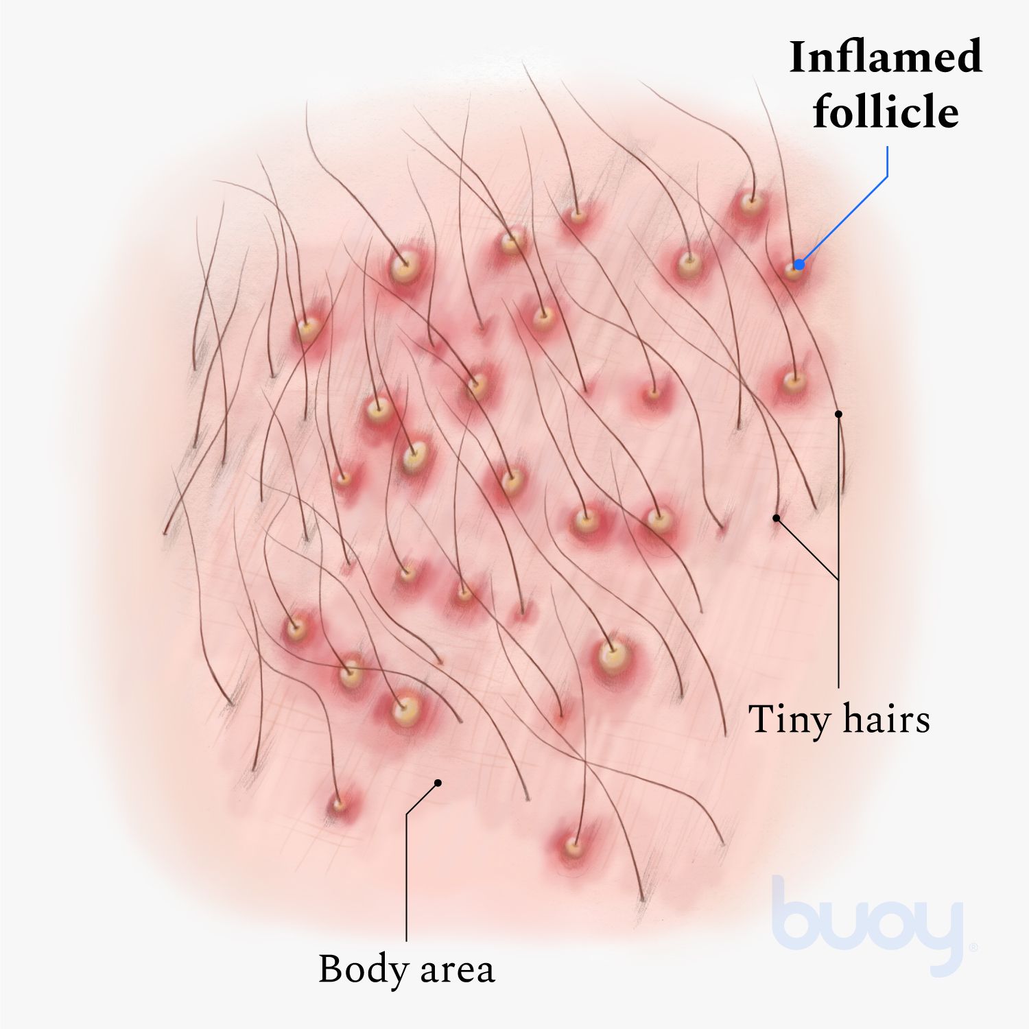 Bacterial infection of hair follicles  Download Scientific Diagram