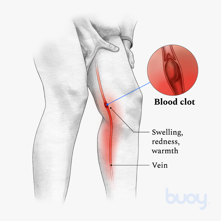 blood clot in upper leg